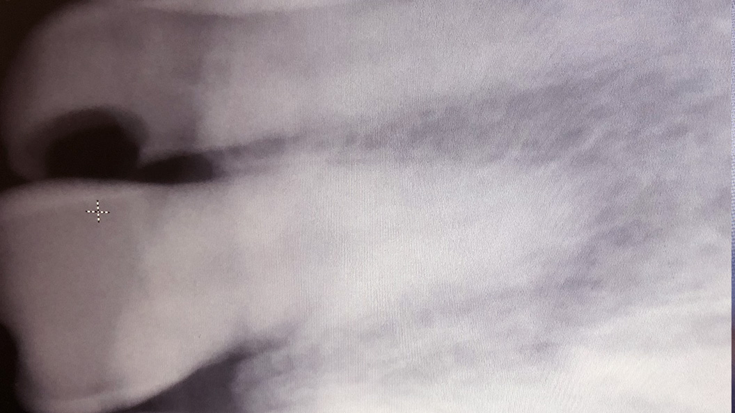 Снимок зуба с хроническим пульпитом
