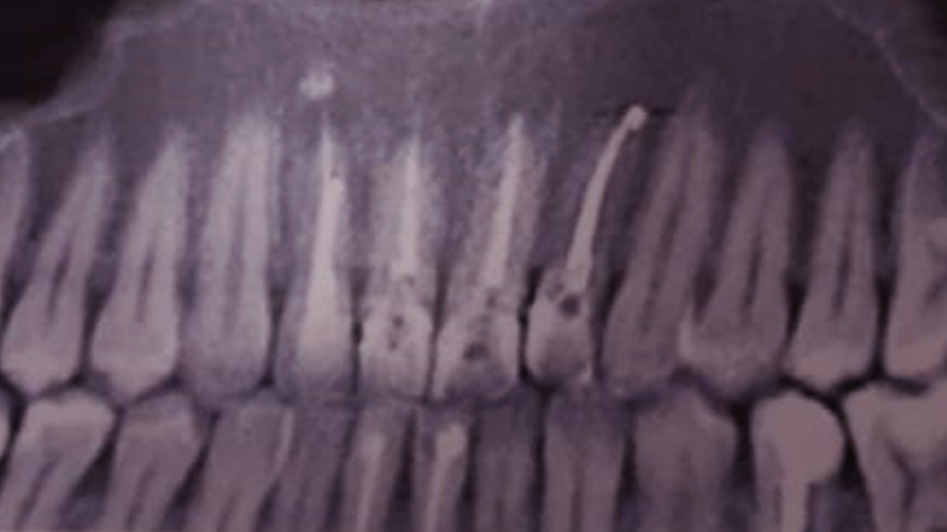 Снимок зуба до имплантации