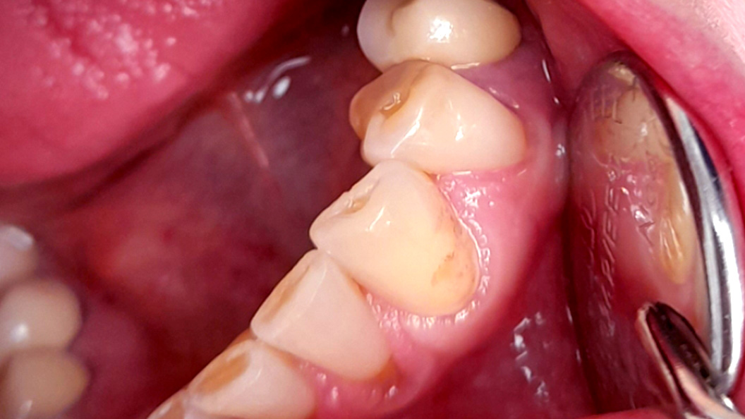 Фото пораженного кариесом зуба
