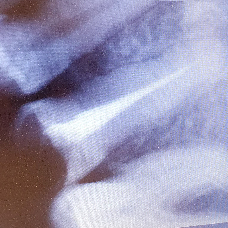 Фото до начала лечения зуба 2