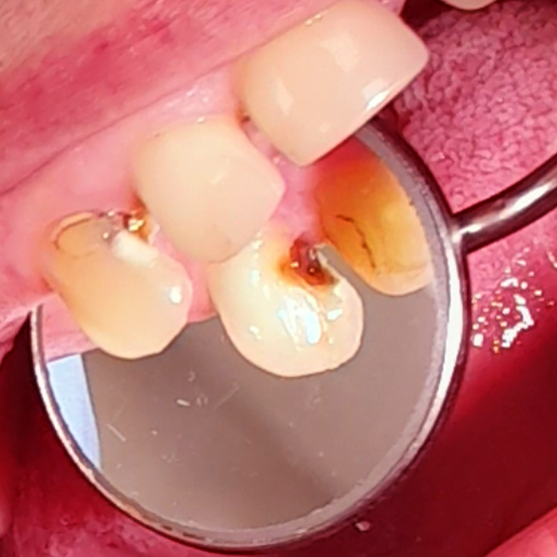 Фото зуба с фиброзным пульпитом 2