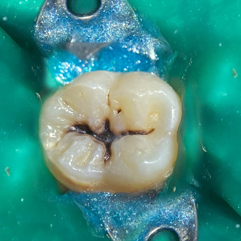 Фото зуба до лечения композитом 2