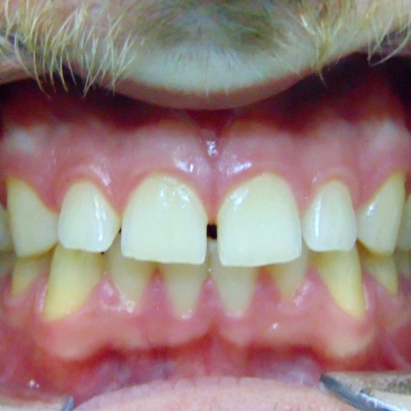 Фото зубов до лечения на элайнерах 2