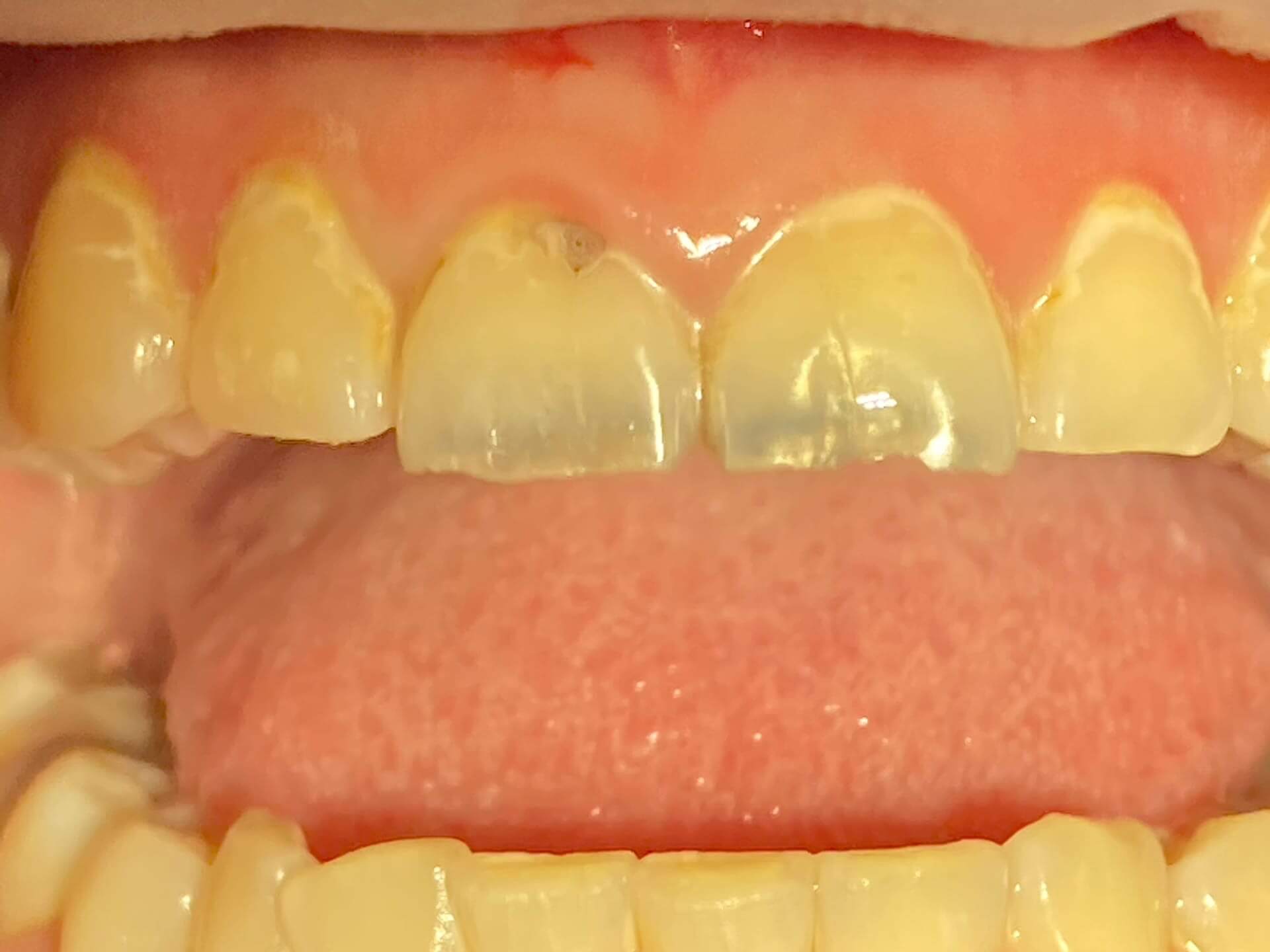 Зубы до лечения кариеса дентина 2