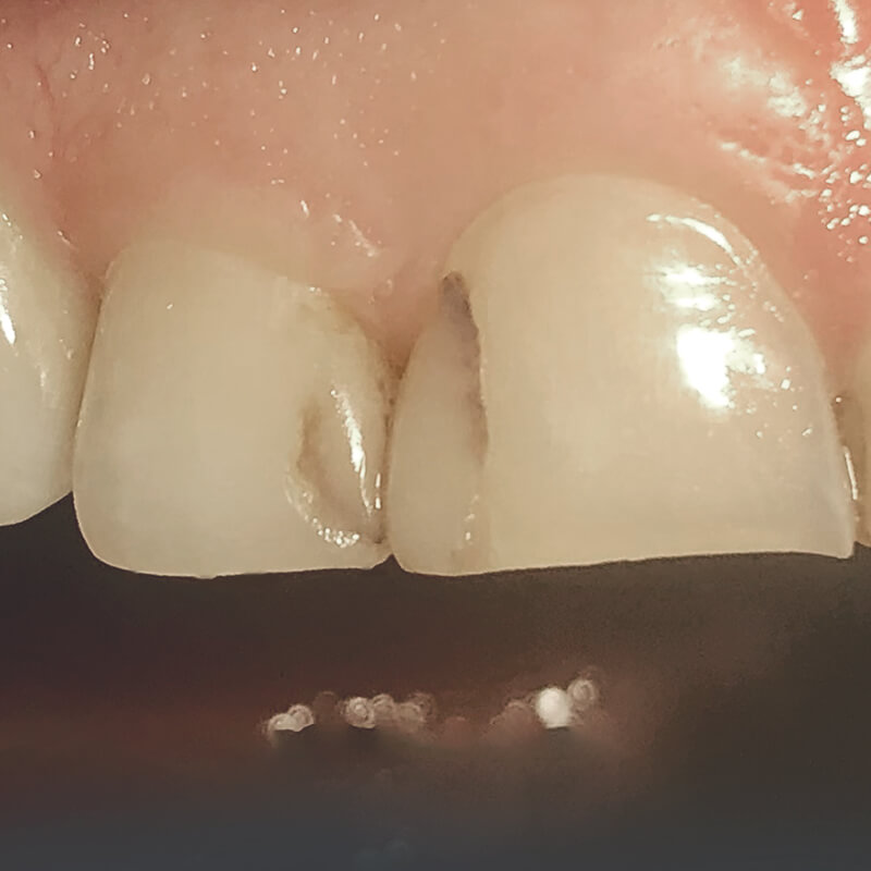 Фото зубов 1.2 и 1.1 до лечения 2