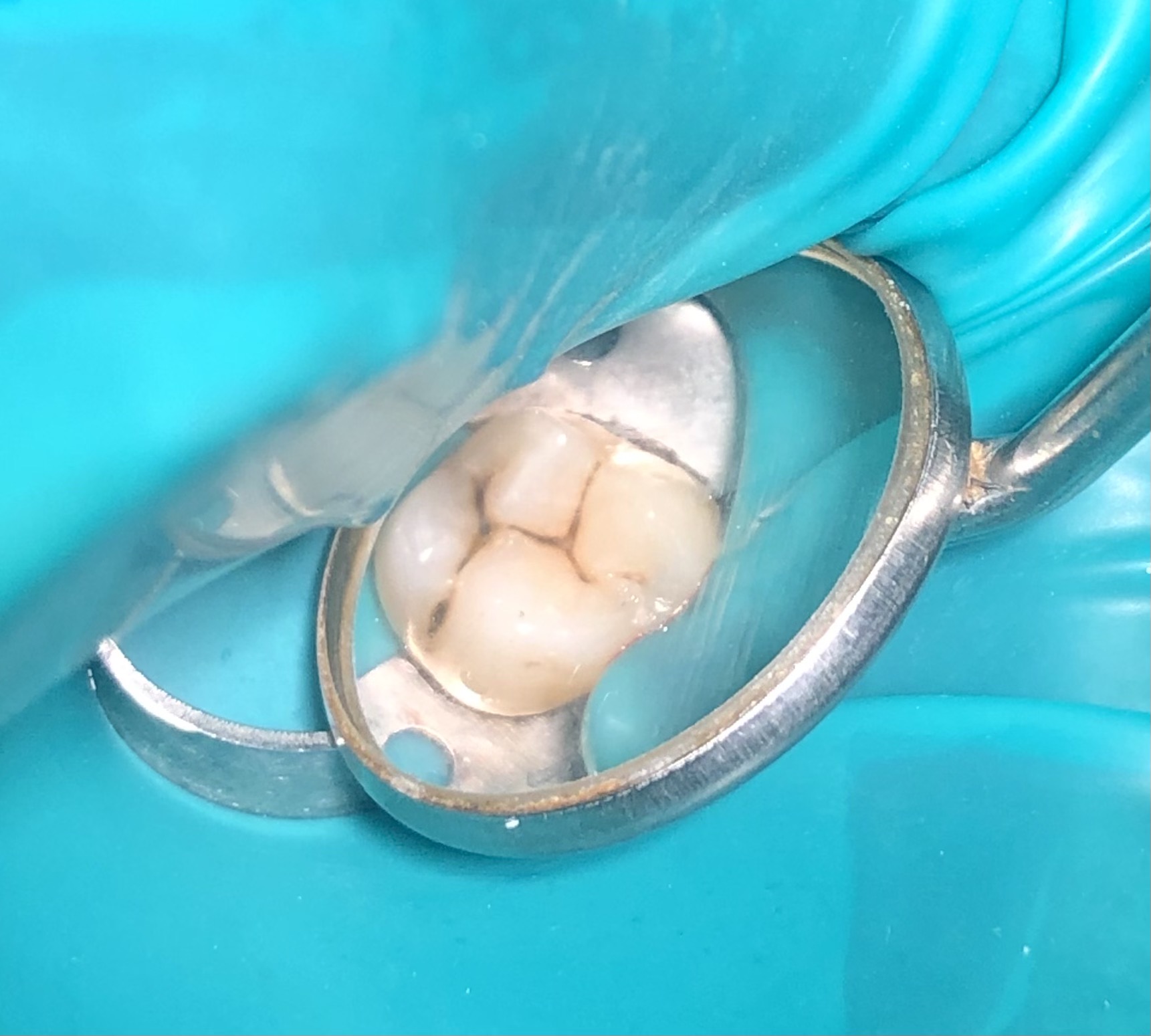 Фото среднего кариеса зуба 2.6