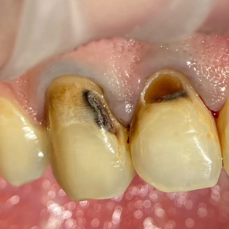 Передние зубы до лечения кариеса 2