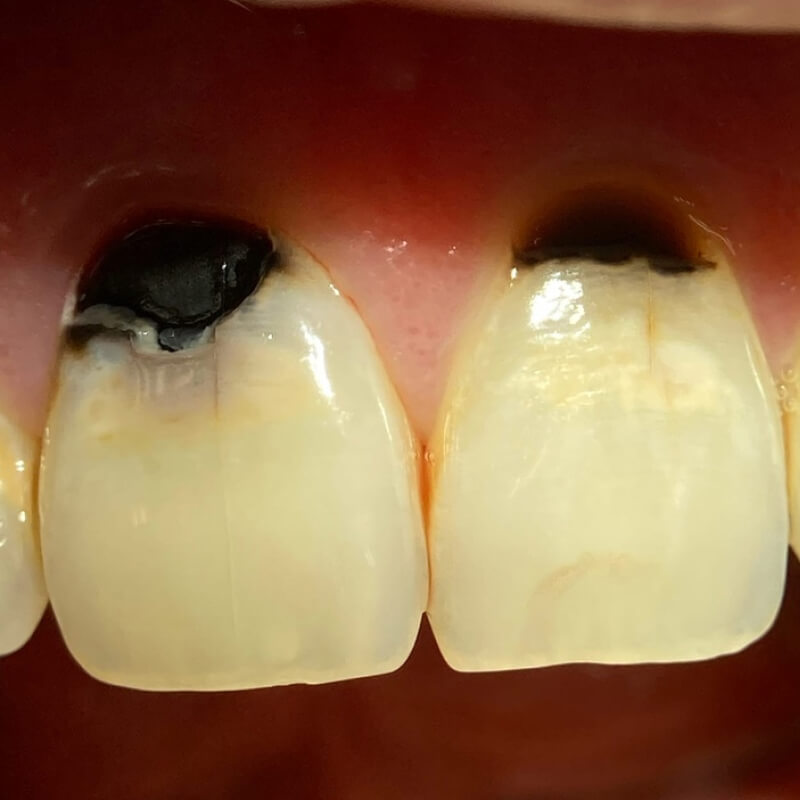 Фото зубов пораженного кариесом 2