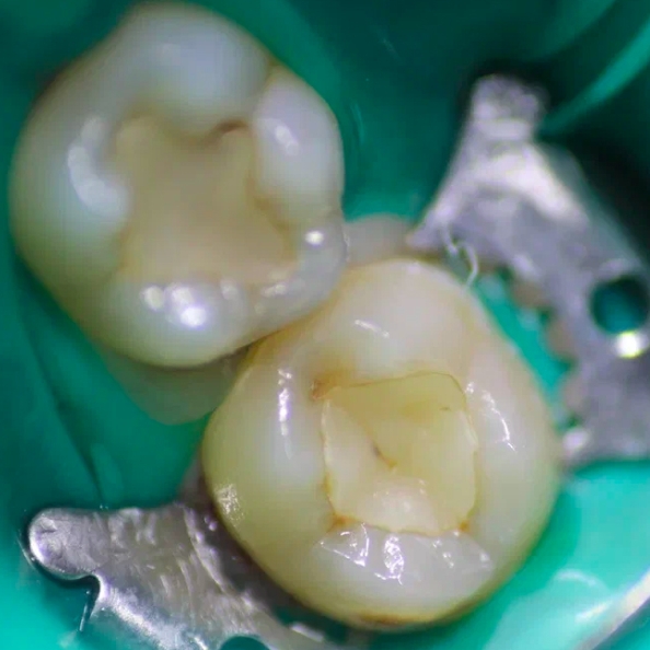 Фото зуба до лечения дентина 2
