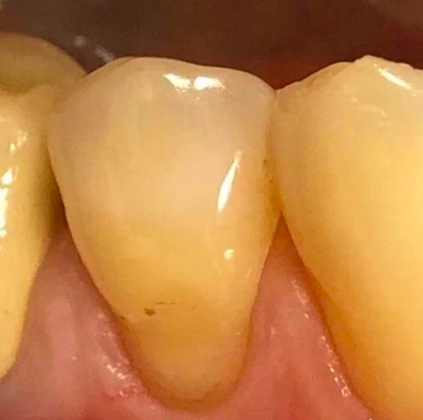 Фото зуба с клиновидным дефектом 2