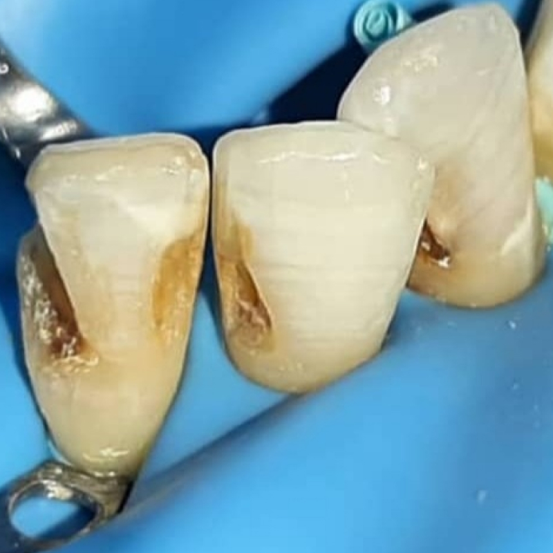 Фото кариеса 3-х зубов до лечения 2