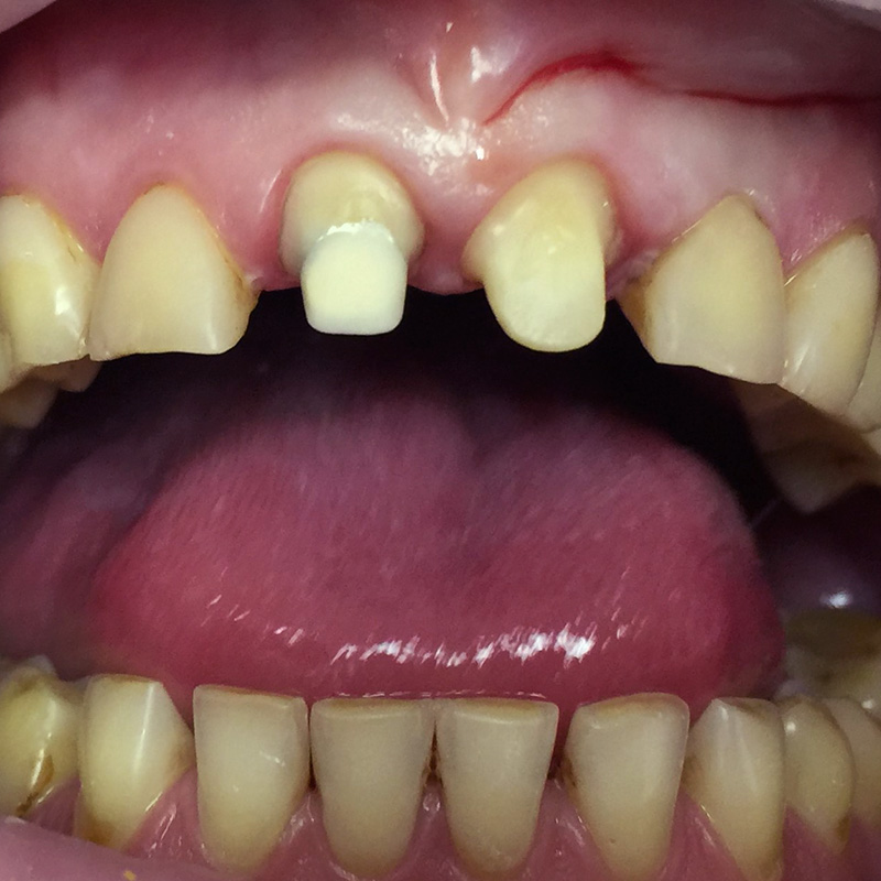 фото после обточки зубов перед протезированием