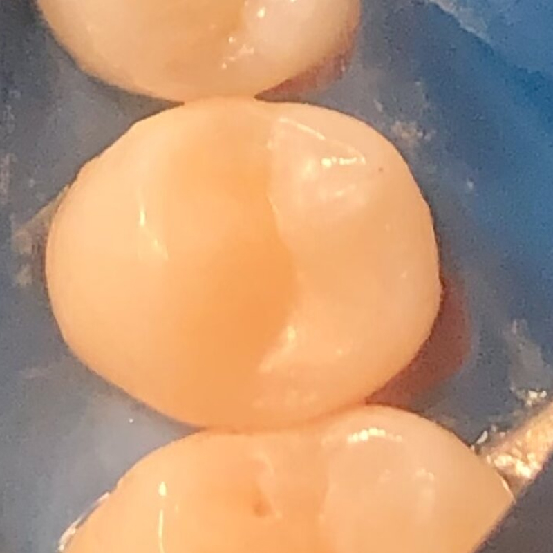 Фото зуба 4.5 до лечения кариеса 2