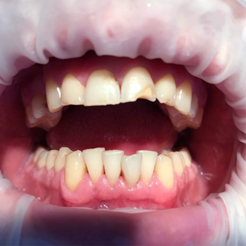 Фото переднего зуба до реставрации 2