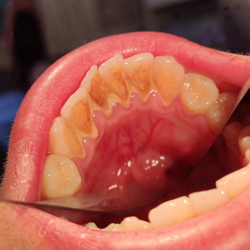 Зубы до удаления зубных отложений 2