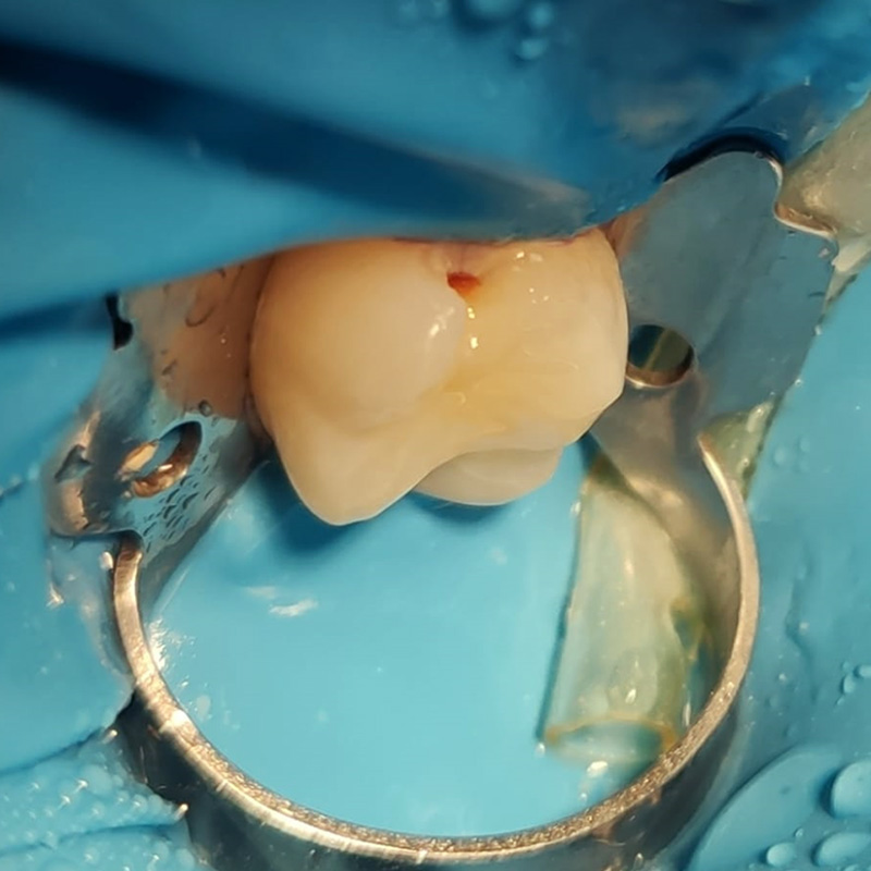 Зуб до лечения переднего кариеса 2