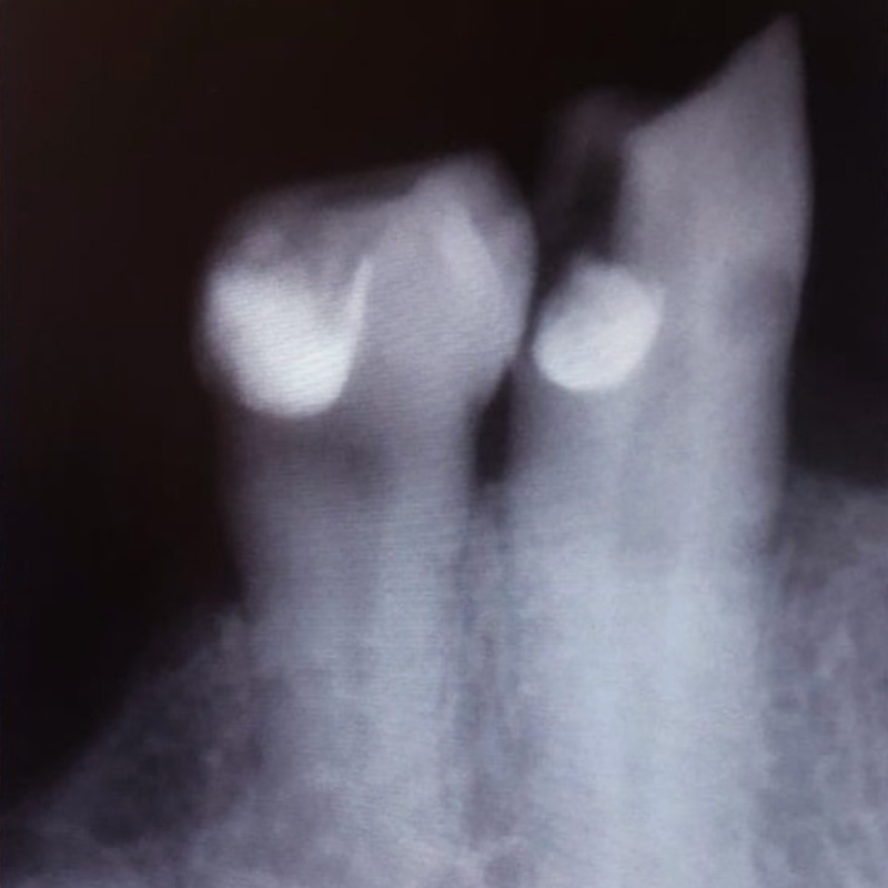 Фото зуба с хроническим пульпитом 2