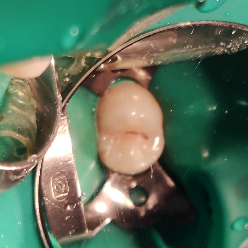 Фото зуба до лечения кариеса 2