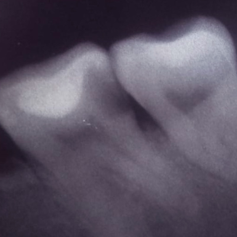 Снимок до лечения зуба 2