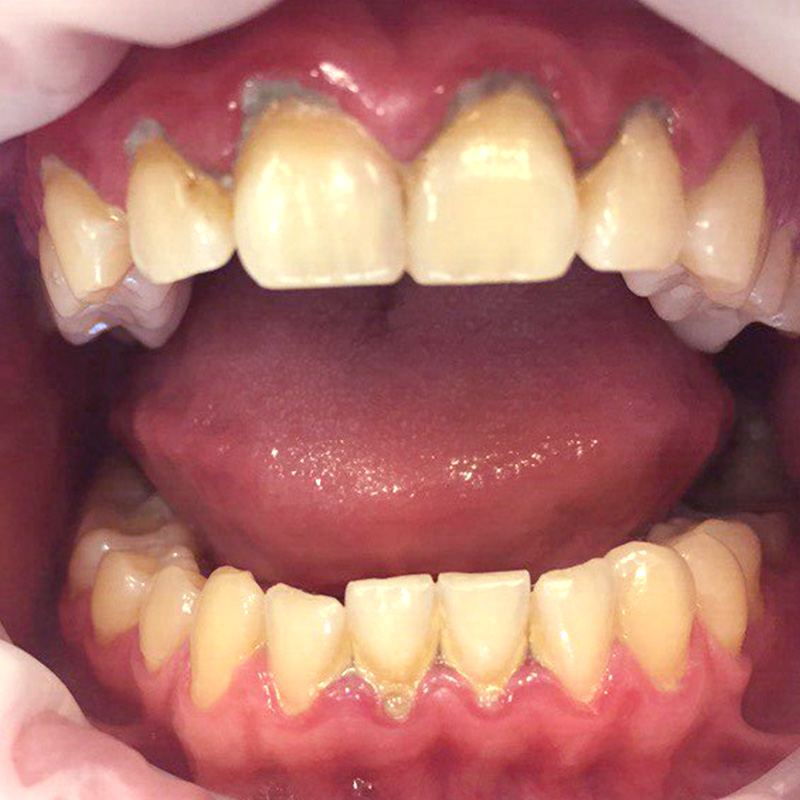 Зубные отложения 2