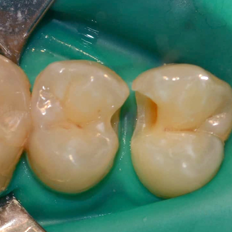 Зубы до чистки и осветления эмали 2