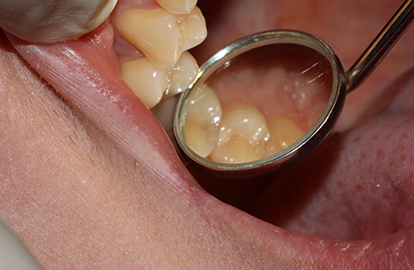 Зубы с кариозными полостями 2