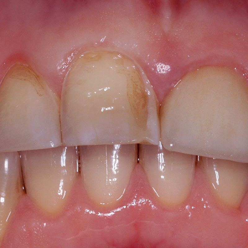Фото дисплазии эмали переднего зуба 2