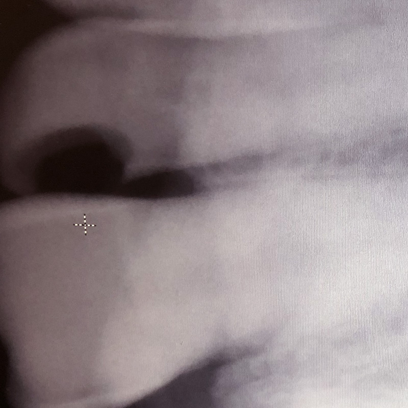 Снимок зуба с хроническим пульпитом 2