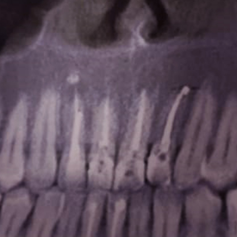 Снимок зуба до имплантации 2