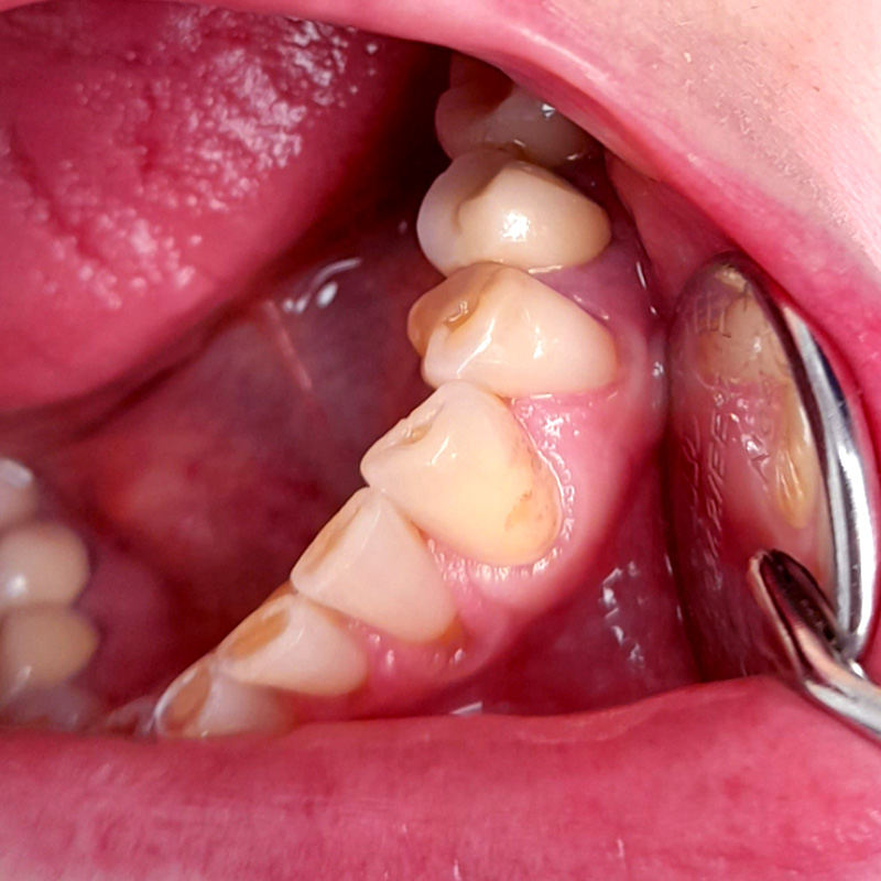 Фото пораженного кариесом зуба 2