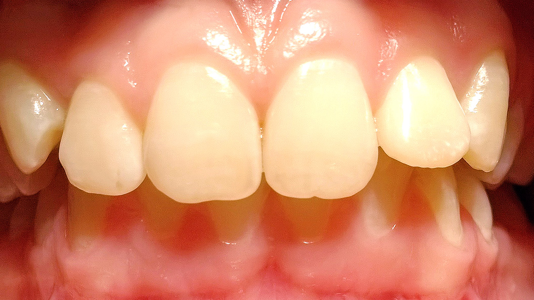 Фото зубов вылеченных с помощью брекетов