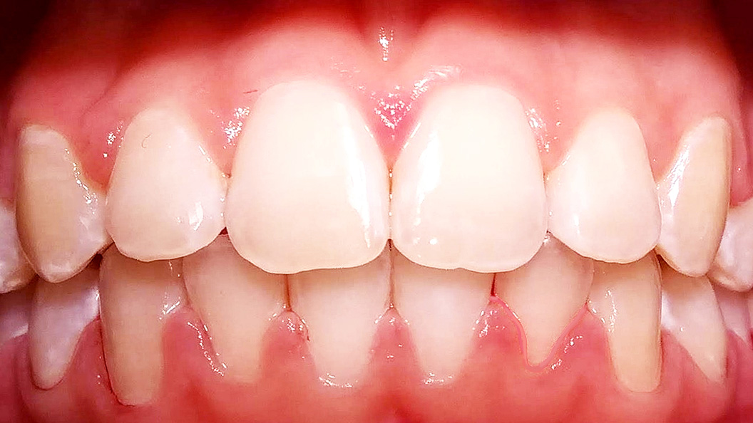 Фото зубов вылеченных с помощью брекетов 2