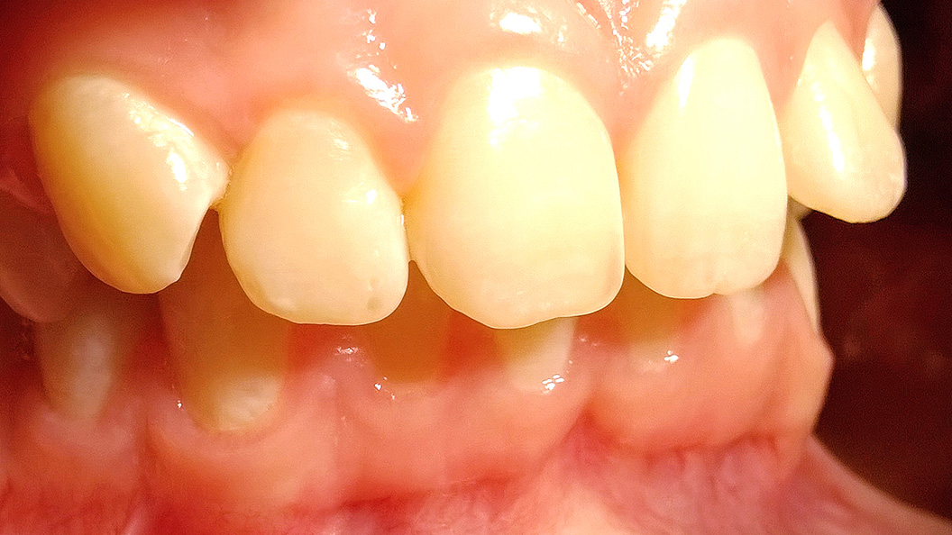 Фото зубов вылеченных с помощью брекетов 3