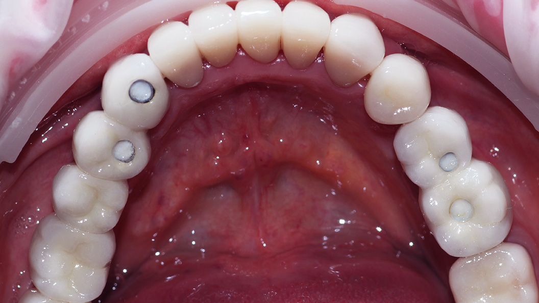 Фото восстановленных зубов