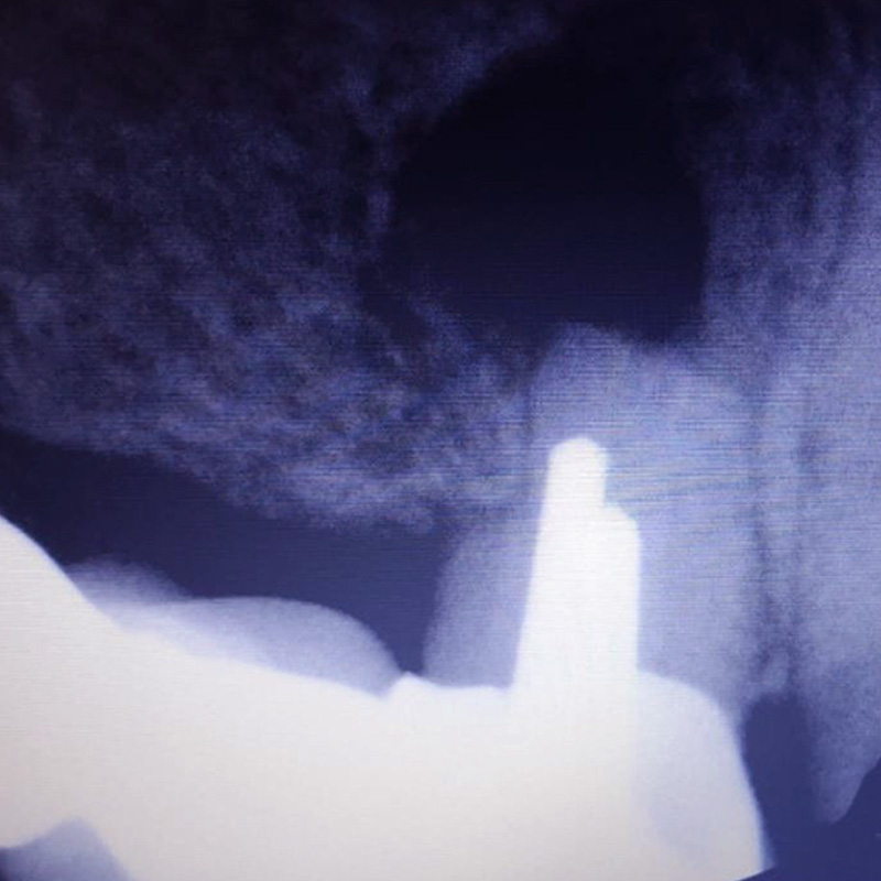 Снимок воспаления в канале зуба