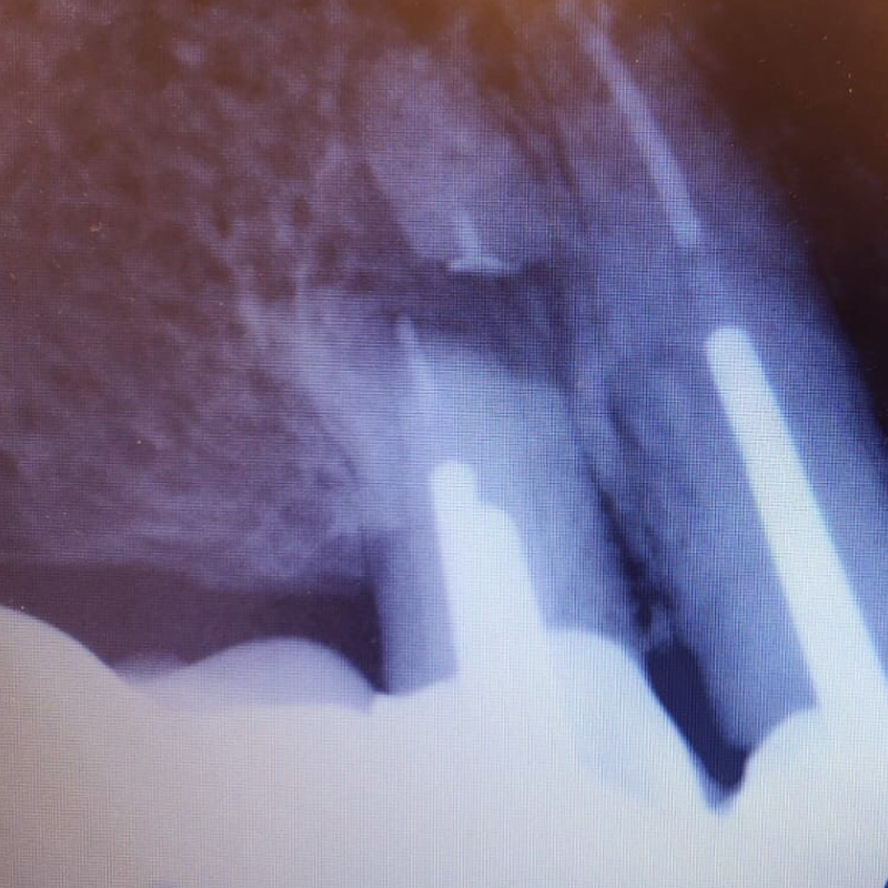 Снимок воспаления в канале зуба 2