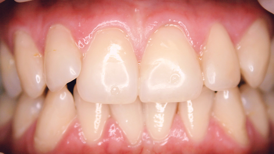 Зубной ряд при скрученности зубов 1