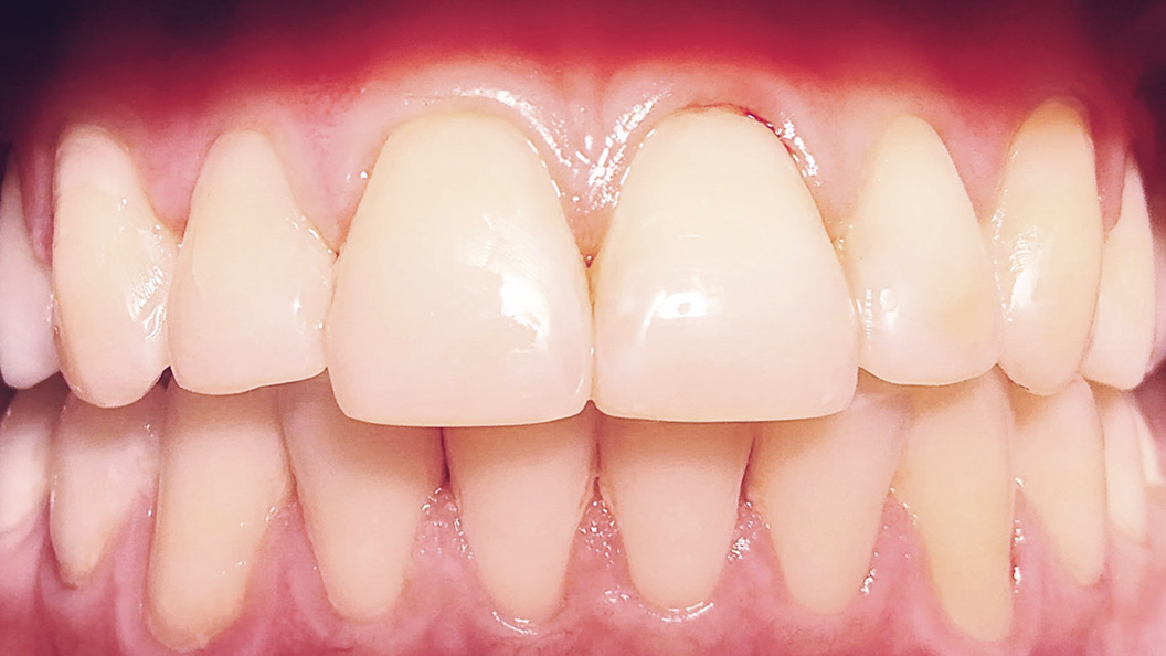 Зубной ряд при скрученности зубов 2