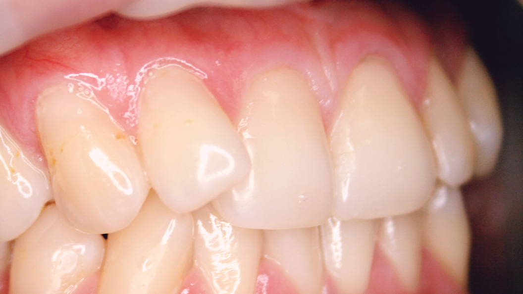 Зубной ряд при скрученности зубов 3