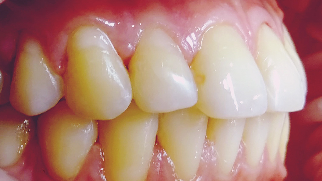 Зубной ряд при скрученности зубов 4