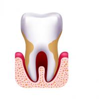 рисунок зуба и мягких тканей пораженных пародонтозом